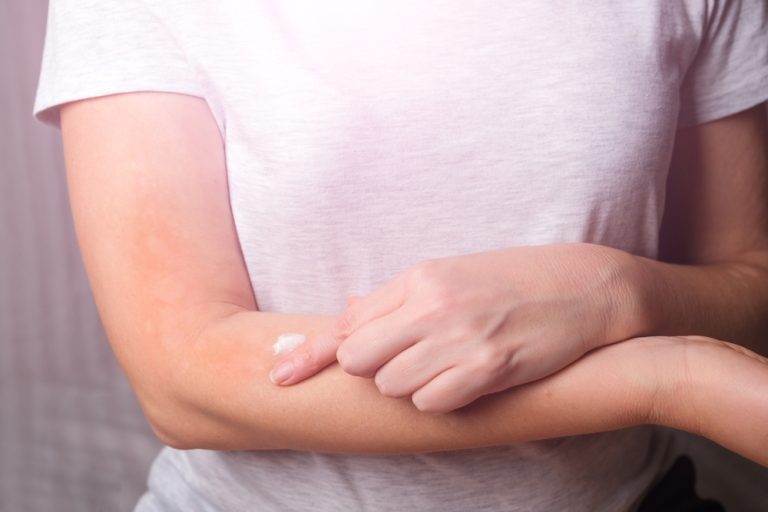 Woman applying fungal cream to arm