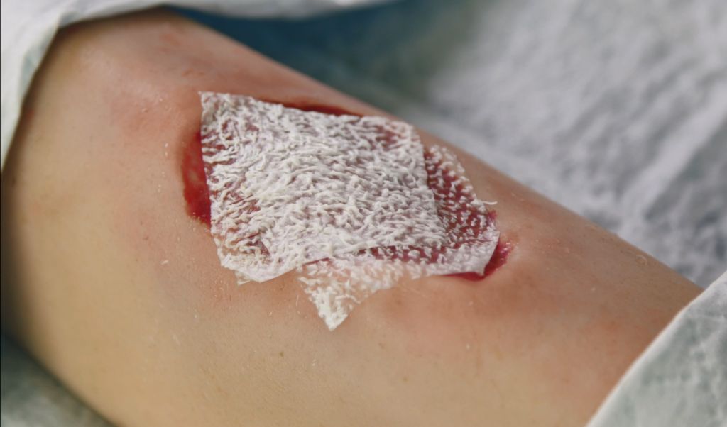 Endoform™ Antimicrobial Restorative Bioscaffold & Indications